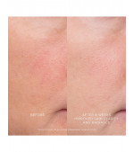 Equilibrium Resurfacing Retinoid Treatment