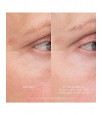 Equilibrium Resurfacing Retinoid Treatment